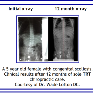 263-TRT Scoliosis in 5 yr old